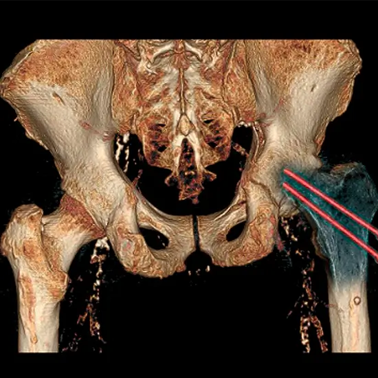 CECT Both Hip Joint